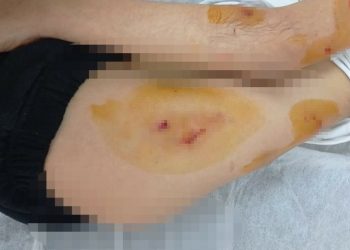 Adıyaman’da sokak köpekleri oyun oynayan çocuğu yaraladı