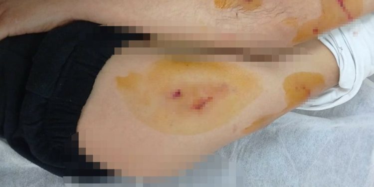 Adıyaman’da sokak köpekleri oyun oynayan çocuğu yaraladı