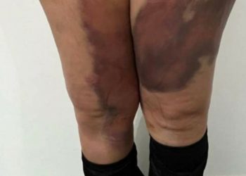 Belçikalı kadın yağ aldırma ameliyatı sonrası sağlığından oldu