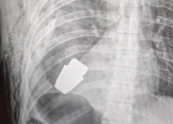 Ukraynalı askerin vücudundan el bombası çıktı