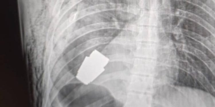 Ukraynalı askerin vücudundan el bombası çıktı